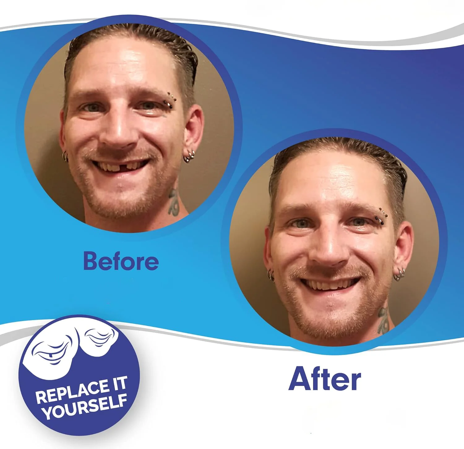 Smile Veneer (Upper & Lower Included) - Image 2
